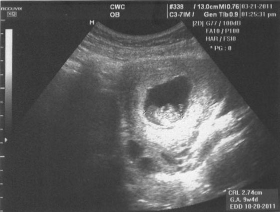 Ultrasound image