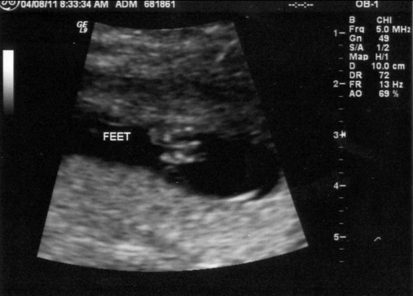 Ultrasound image