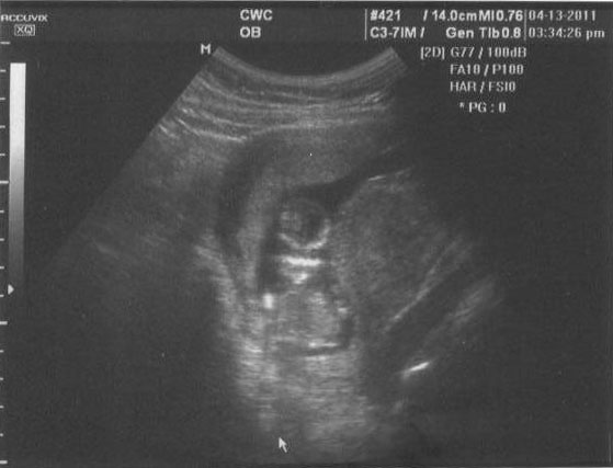 Ultrasound image