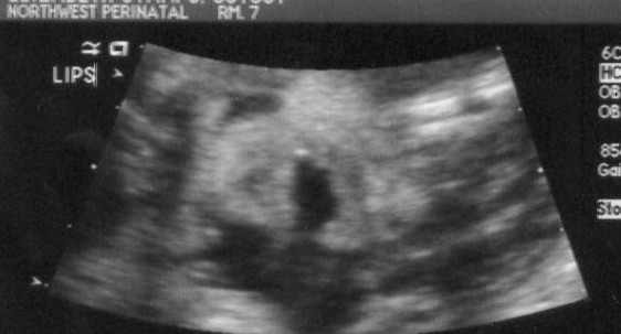 Ultrasound image