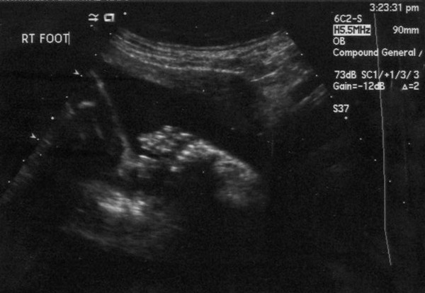 Ultrasound Picture