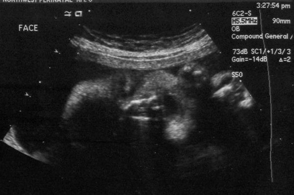 Ultrasound Picture